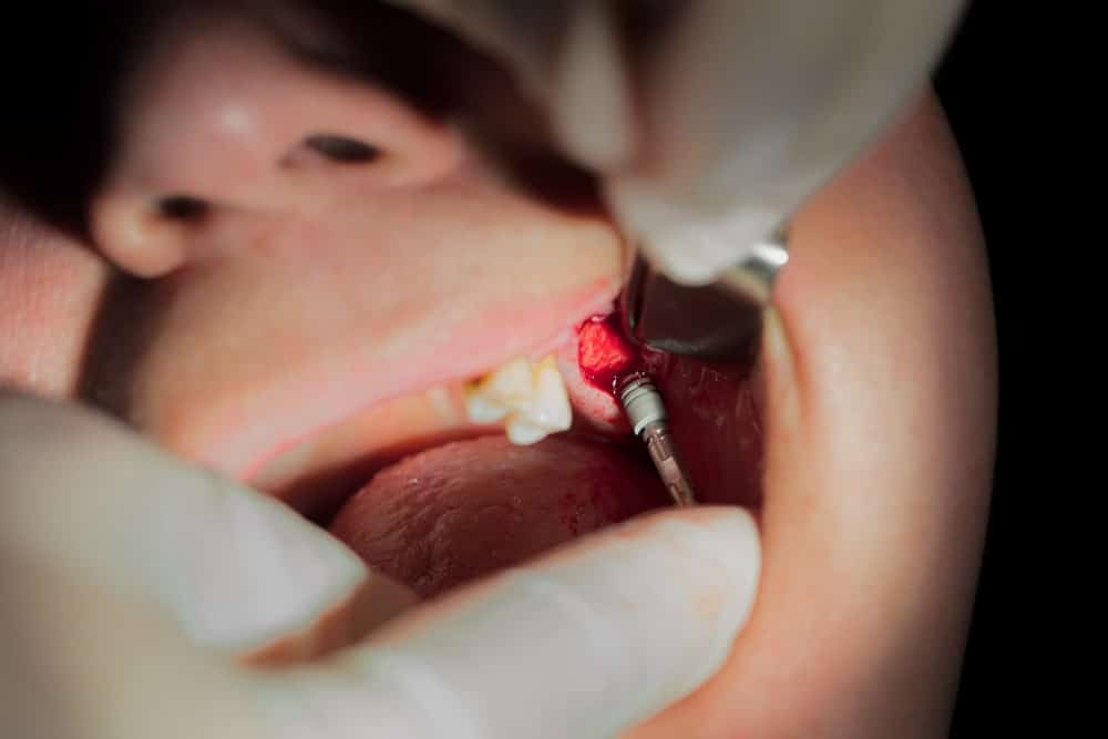 Frenectomy Melbourne Family Dentist