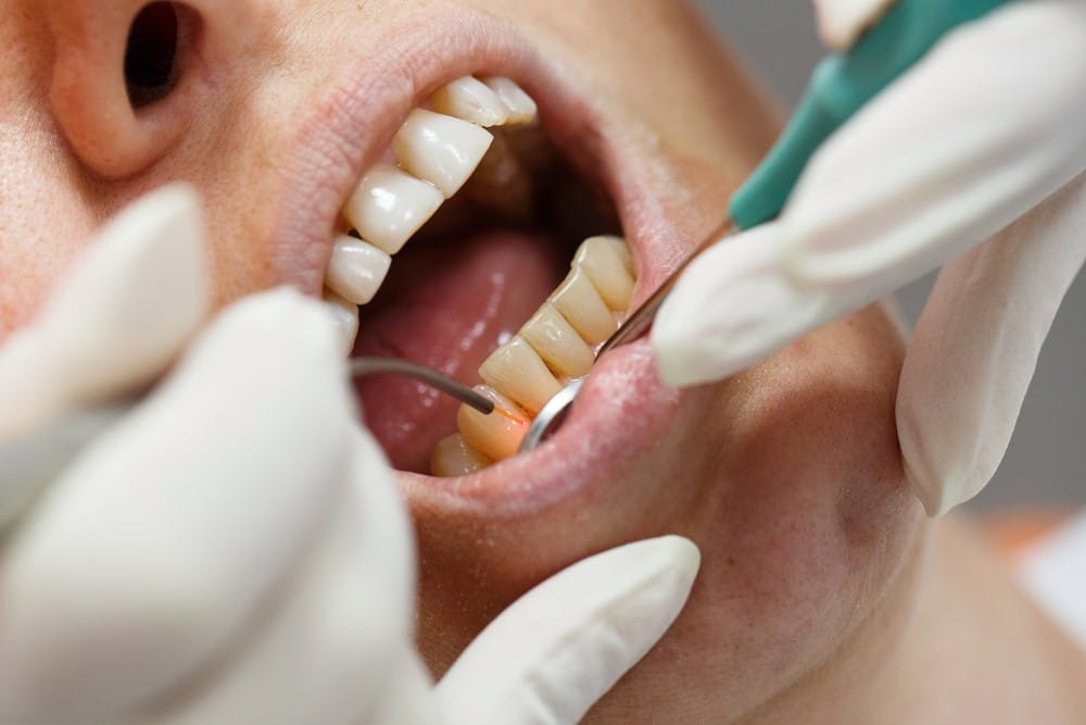 Soft Tissue Procedures Melbourne Family Dentist
