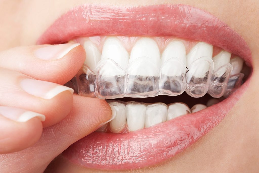 Invisalign