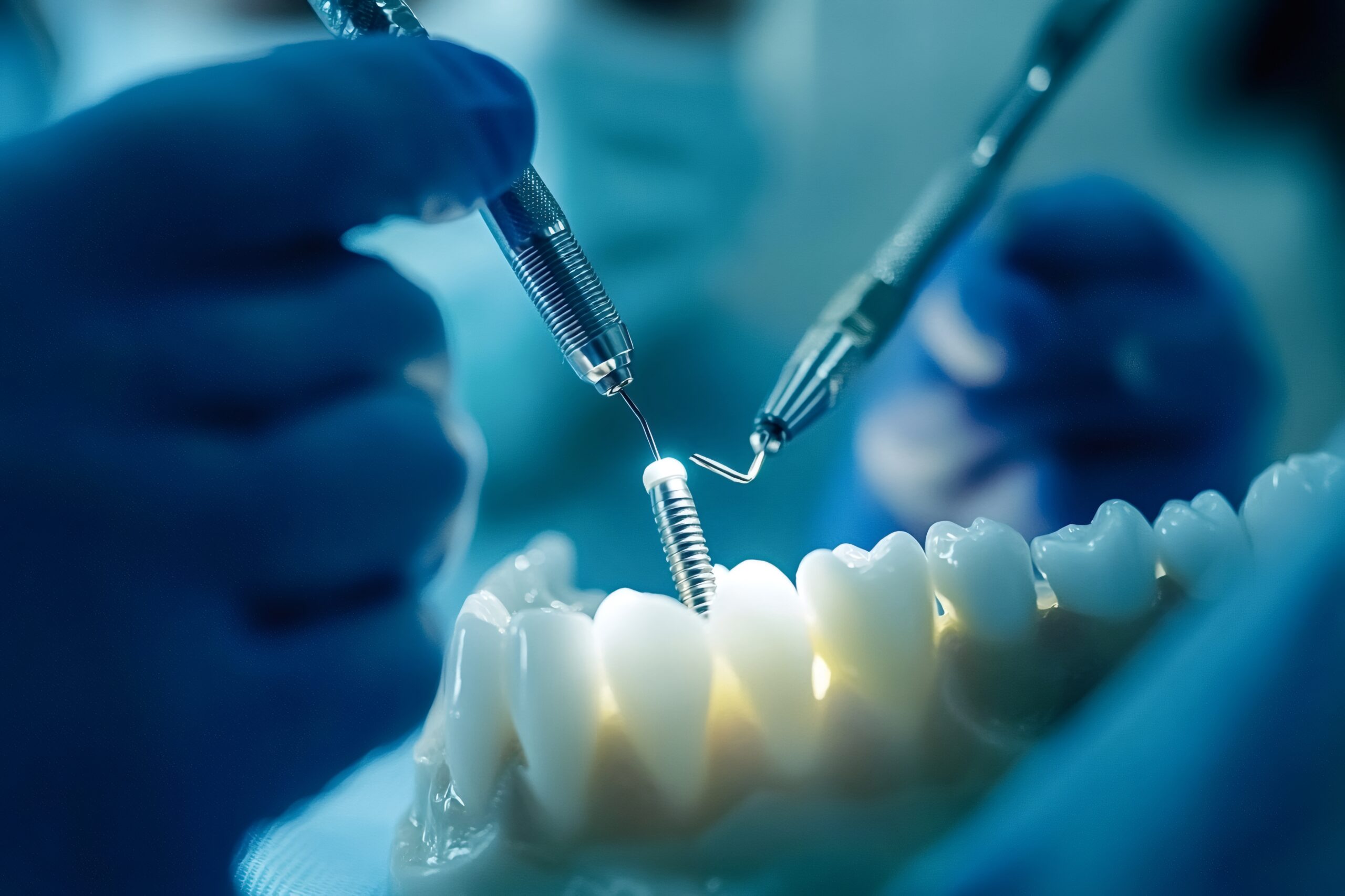 Root Canal Treatment