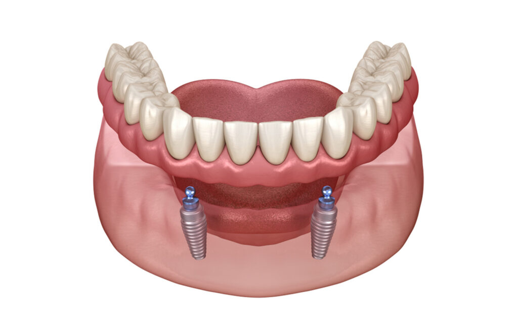 Implant-Supported Dentures