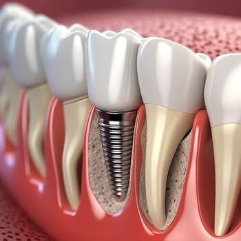 Single Tooth Implants