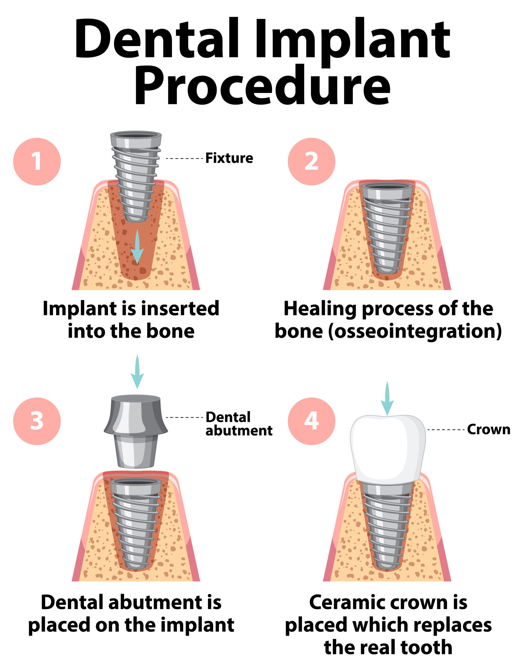 Our Dental Implant Procedure